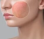 Skin Barrier Rusak, Perawatan Wajah Tak Akan Berarti